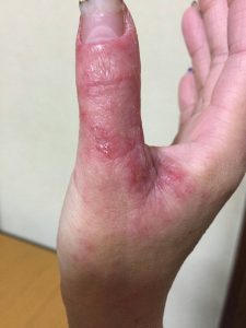 アトピー性皮膚炎ー親指②