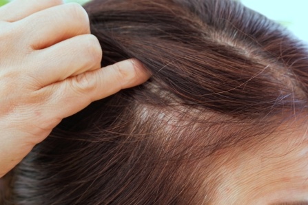 薄毛で悩む女性