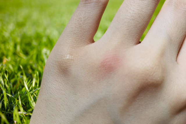 蚊に刺された時にもシュッとひと吹き